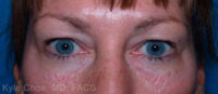 Blepharoplasty (Eyelid Surgery)