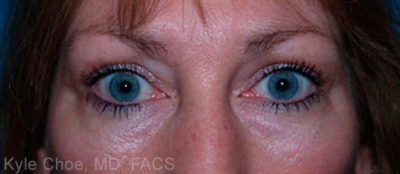 Blepharoplasty (Eyelid Surgery)