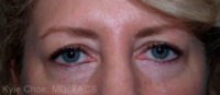 Blepharoplasty (Eyelid Surgery)