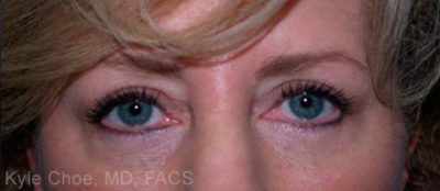 Blepharoplasty (Eyelid Surgery)