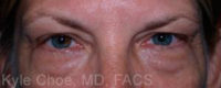 Blepharoplasty (Eyelid Surgery)