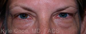 Blepharoplasty (Eyelid Surgery)