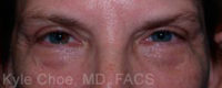 Blepharoplasty (Eyelid Surgery)