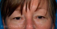 Blepharoplasty (Eyelid Surgery)