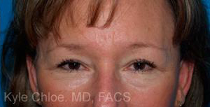 Blepharoplasty (Eyelid Surgery)