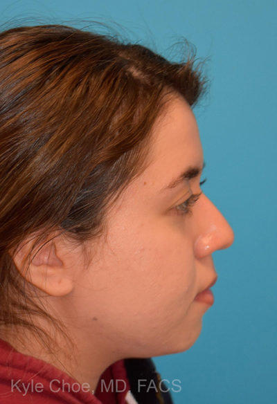 Non-Surgical Rhinoplasty