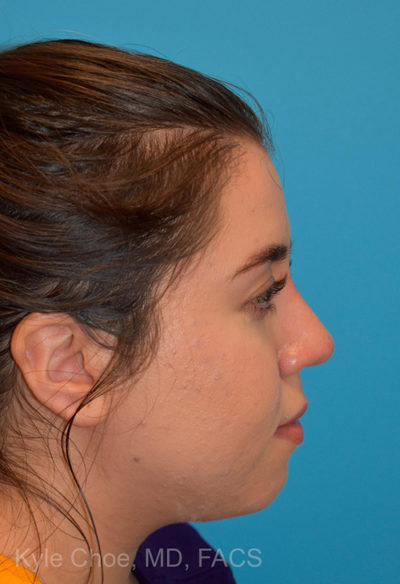 Non-Surgical Rhinoplasty