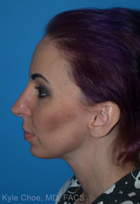 Chin Augmentation