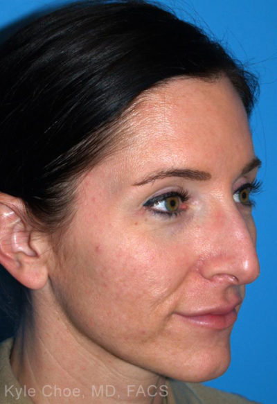 Rhinoplasty