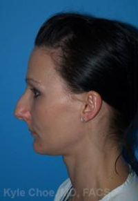 Rhinoplasty