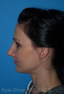 Rhinoplasty