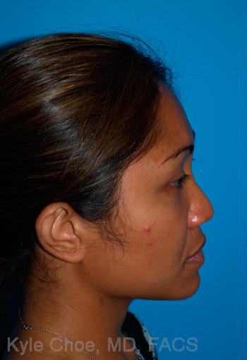 Rhinoplasty