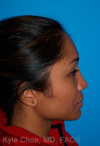 Rhinoplasty