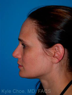 Rhinoplasty