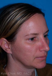 Rhinoplasty