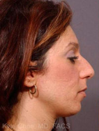 Rhinoplasty