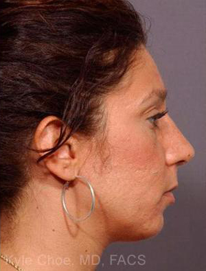 Rhinoplasty