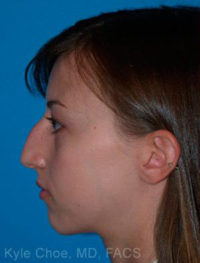 Rhinoplasty