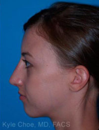 Rhinoplasty