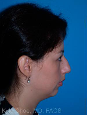 Rhinoplasty