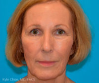 Endoscopic Brow Lift