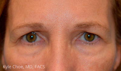 Endoscopic Brow Lift