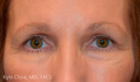 Endoscopic Brow Lift