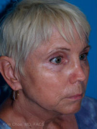 Laser Skin Resurfacing