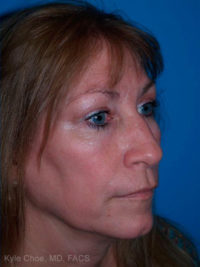 Laser Skin Resurfacing