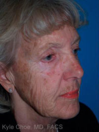 Laser Skin Resurfacing