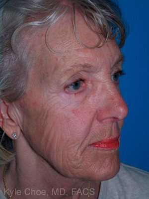 Laser Skin Resurfacing