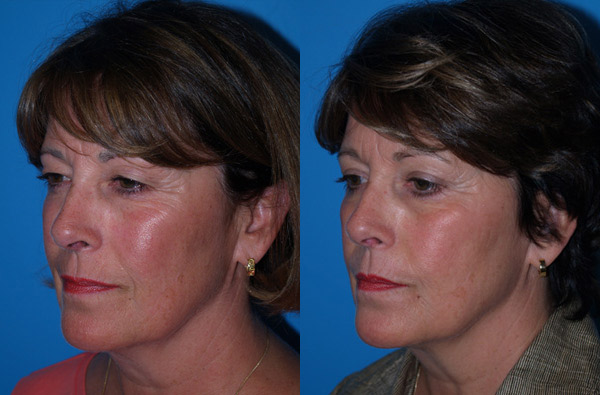 Ultherapy patient