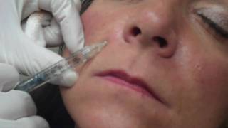 Dr. Choe injects Juvederm to smile lines (Nasolabial folds)