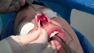 Open Technique Rhinoplasty