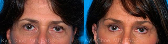  before and after photos in , , Brow Lift in Virginia Beach, VA