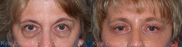  before and after photos in , , Brow Lift in Virginia Beach, VA
