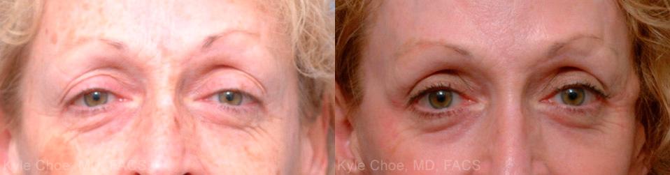  before and after photos in , , Blepharoplasty in Virginia Beach, VA