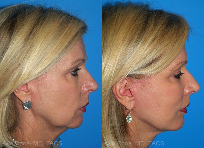  before and after photos in , , Neck Lift in Virginia Beach, VA