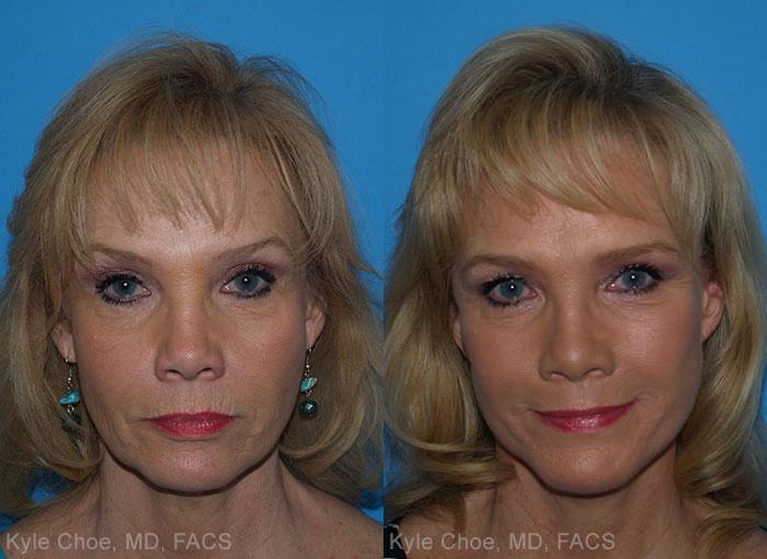  before and after photos in , , Facelift in Virginia Beach, VA