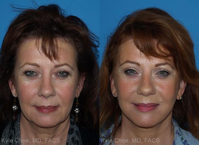 before and after photos in , , Facelift in Virginia Beach, VA