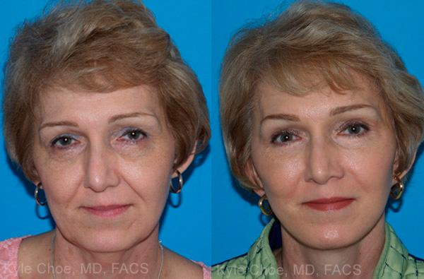  before and after photos in , , Mid-Face Lift in Virginia Beach, VA