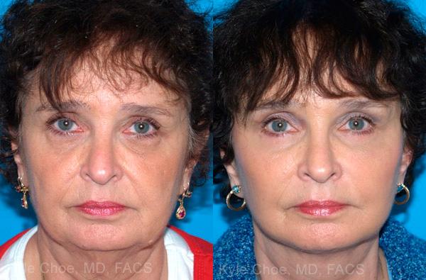  before and after photos in , , Mid-Face Lift in Virginia Beach, VA