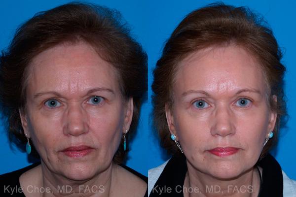  before and after photos in , , Mini-Facelift in Virginia Beach, VA