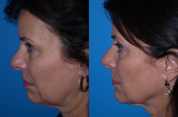 Ultherapy Treatment Results Virginia Beach, VA