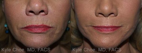  before and after photos in , , Microdermabrasion in Virginia Beach, VA