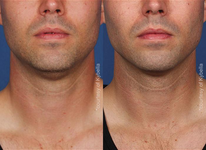  before and after photos in , , Kybella in Virginia Beach, VA