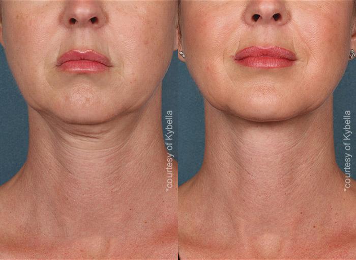  before and after photos in , , Kybella in Virginia Beach, VA