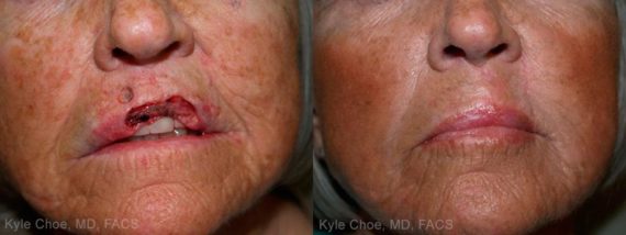  before and after photos in , , Reconstructive Surgery in Virginia Beach, VA