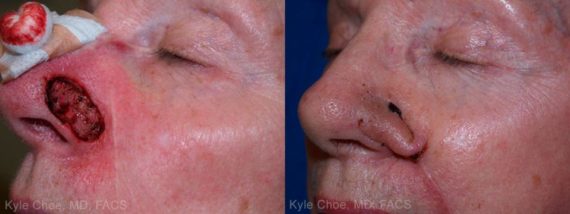  before and after photos in , , Reconstructive Surgery in Virginia Beach, VA