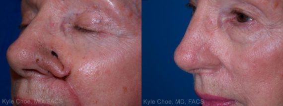  before and after photos in , , Reconstructive Surgery in Virginia Beach, VA